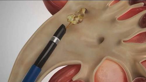 MUŞ´A BÖBREK TAŞI KIRMA MAKİNESİ